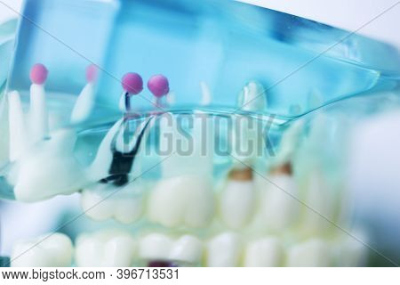 Tooth Decay Dental Model