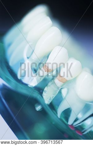 Tooth Decay Dental Model