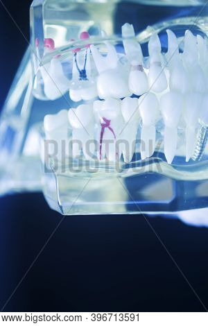 Tooth Decay Dental Model