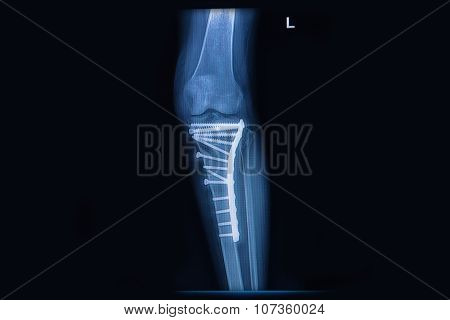 X-ray Of Fracture Tibia(leg Bone). Tibia Bone With Internal Fixed By Plate&screw