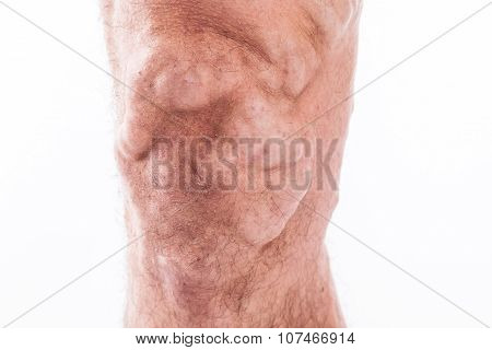 People With Varicose Veins Of The Lower Extremities And Venous Thrombophlebitis And Standing On A Wh