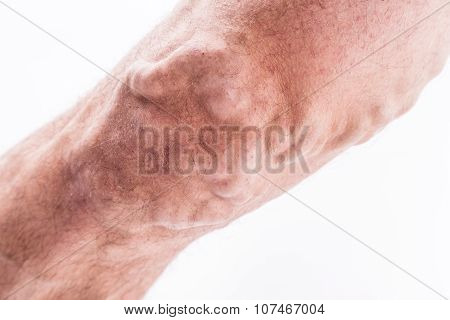 People With Varicose Veins Of The Lower Extremities And Venous Thrombophlebitis And Standing On A Wh