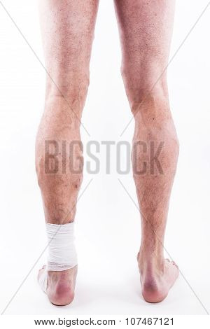 People With Varicose Veins Of The Lower Extremities And Venous Thrombophlebitis And Standing On A Wh