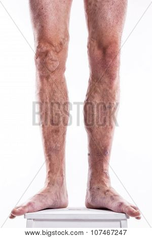 People With Varicose Veins Of The Lower Extremities And Venous Thrombophlebitis And Standing On A Wh