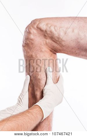 Doctor In Medical Gloves Examines A Person With Varicose Veins Of The Lower Extremities And Venous T