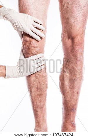 Doctor In Medical Gloves Examines A Person With Varicose Veins Of The Lower Extremities And Venous T