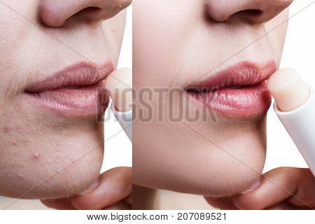 Beautiful woman applying hygienic lip balm. Before and after retouch. Skin Care Concept.