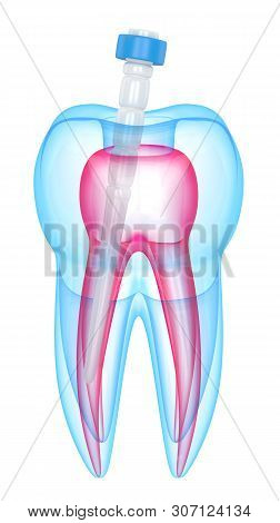 3d Render Of Tooth With Fiber Post Over White Background