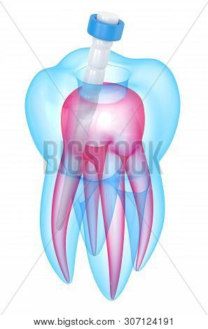 3d Render Of Tooth With Fiber Post Over White Background
