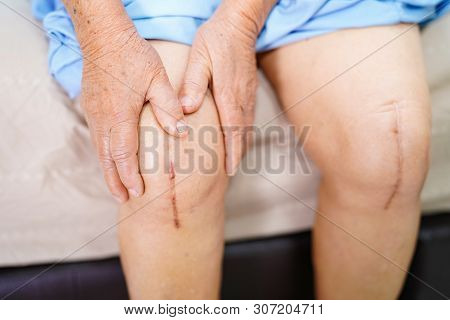 Asian Senior Or Elderly Old Lady Woman Patient Show Her Scars Surgical Total Knee Joint Replacement 