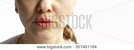 Part Of A Young Woman Face With Red Bubbles Of Virus Herpes On Lips Medicine, Treatment. Long Horizo