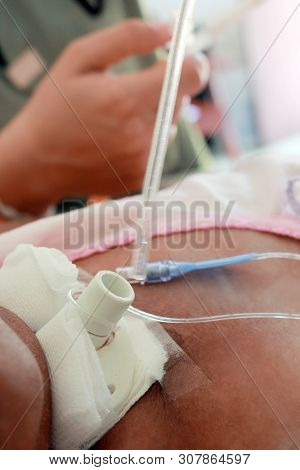 Use Sputum Suction Hose For Patients Who Have Been Pierced In The Neck.