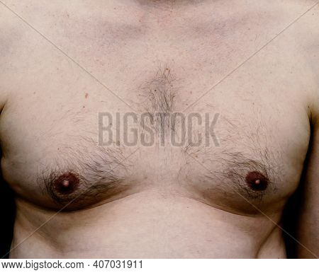 Breast And Chest Of An Adult White Male With Weight Issues, Man Boobs. Isolated On Black Background.
