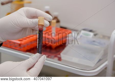 The Doctor Holds A Vacutainer With Human Blood.