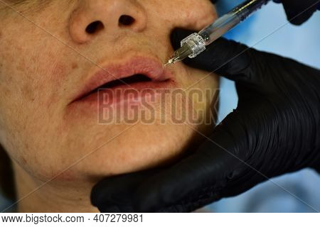 Closeup Woman Lips, Procedure Augmentation. Syringe Female Mouth, Hyaluronic Acid Injection, Augment