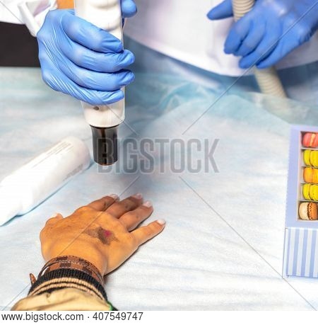 Laser Peeling Procedure In A Cosmetic Clinic. A Dermatologist Doctor Cleans The Skin On The Patients