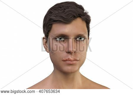 Herpes Labialis, Also Known As Cold Sores, 3d Illustration Showing Lesions On The Man's Lips Caused 