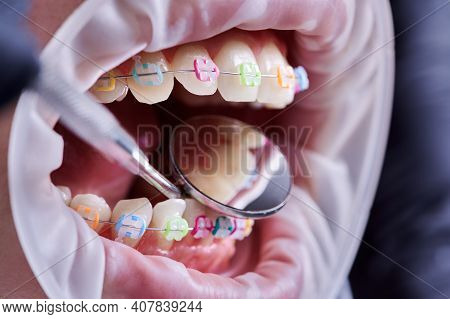 Close Up Of Orthodontist Checking Patient Brackets With Dental Mirror. Person With Cheek Retractor I