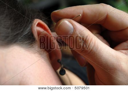 เข็ม Acupunture ในหู