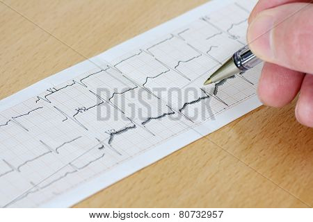 Arrhythmia
