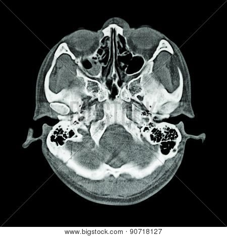 Ct Scan Of Brain And Base Of Skull  ( Bone Window )