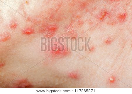Nodular Cystic Acne Skin