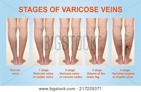 Varicose veins on a female senior legs. The stages of varicose veins