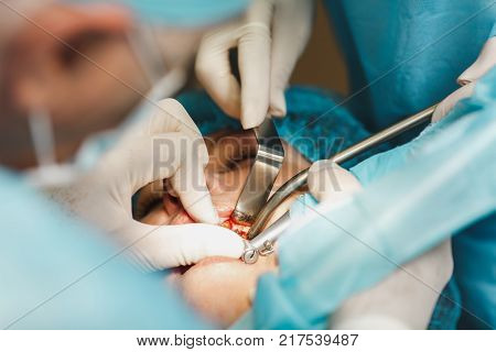 Process Of Preparing And Installing Dental Ceramic Crown. Male Professional Dentist And Female Assis