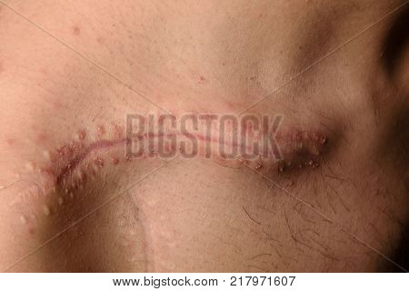 Detail Of A Scar On The Clavicle