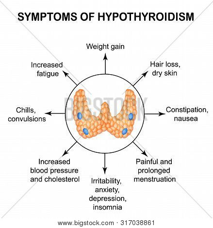 Symptoms Of Hypothyroidism. Thyroid. Infographics. Illustration On Isolated Background.