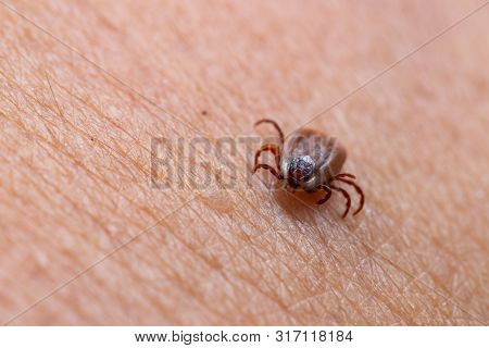 Tick Filled With Blood Sitting On Human Skin.