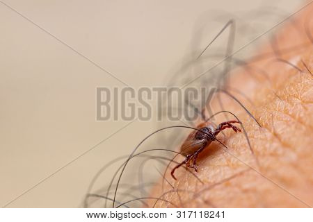 Tick Filled With Blood Sitting On Human Skin.