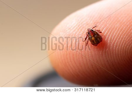 Tick Filled With Blood Sitting On Human Skin.
