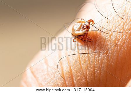 Tick Filled With Blood Sitting On Human Skin.