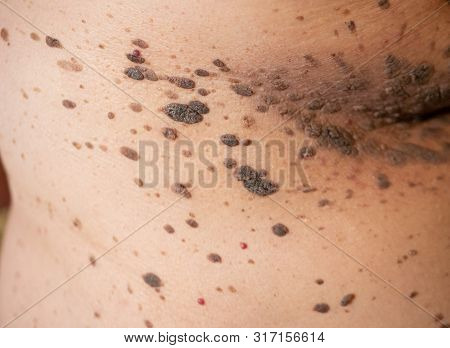 Closeup Of Large Brown Nevus Moles On Human Body Skin