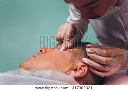 Close-up Of Procedure For Face Lifting Pdo Suture Operation, Face Lifting Surgery. Innovative Techni