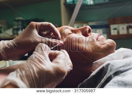 Close-up Of Procedure For Face Lifting Pdo Suture Operation, Face Lifting Surgery. Innovative Techni