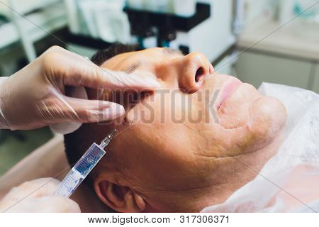 Close-up Of Procedure For Face Lifting Pdo Suture Operation, Face Lifting Surgery. Innovative Techni