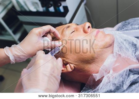 Close-up Of Procedure For Face Lifting Pdo Suture Operation, Face Lifting Surgery. Innovative Techni