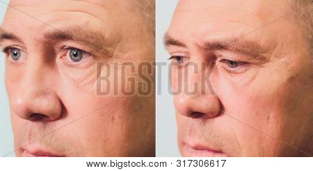 Close-up Of Procedure For Face Lifting Pdo Suture Operation, Face Lifting Surgery. Innovative Techni