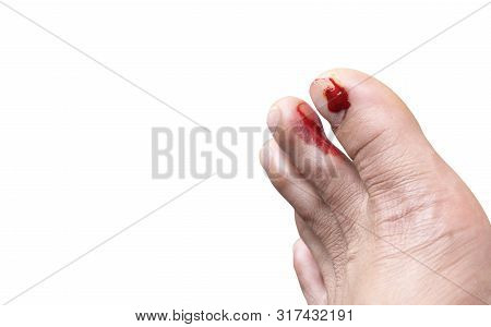 Fresh Wounds On The Floor Man Toe Nails On Isolated White Background.
