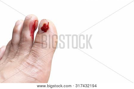 Fresh Wounds On The Floor Man Toe Nails On Isolated White Background.