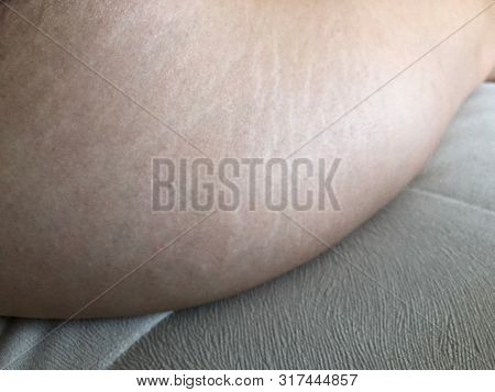 Woman Is Testing The Skin On The Thigh For The Presence Of Cellulite