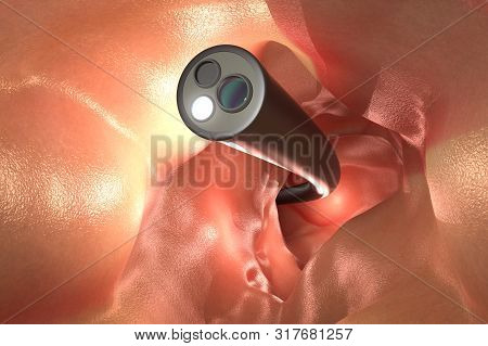 3d Rendering X-ray Endoscope Remove Colonic Polyp With Wire Loop