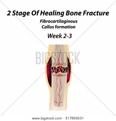 2 Stage Of Healing Bone Fracture. Formation Of Callus. The Bone Fracture. Infographics. Illustration