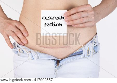 Woman Belly With Scar And Caesarean Section Text On White Sticker. Five Months After Surgery.