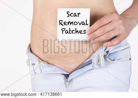 A Woman Applied A Silicone-coated Patch To A Cesarean Section Scar To Remove Keloid Scars. In Her Ha