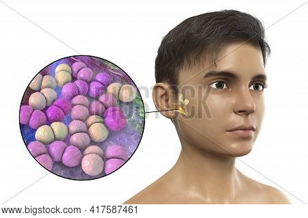 Streptococcus Pneumoniae Bacterium As A Cause Of Otitis Media. 3d Illustration Showing Purulent Infl