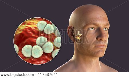 Streptococcus Pneumoniae Bacterium As A Cause Of Otitis Media. 3d Illustration Showing Purulent Infl