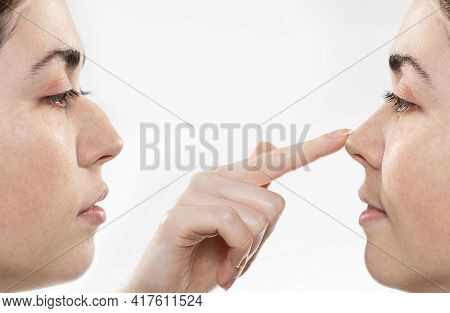 Rhinoplasty. Two Female Faces Close-up Showing The Result Before And After Rhinoplasty. The Index Fi